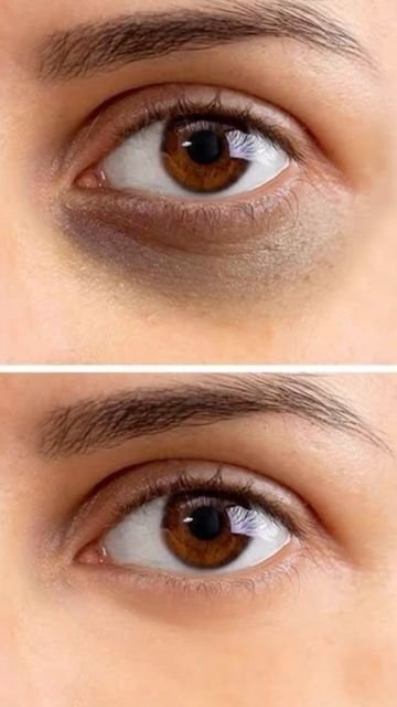 Under-eye Dark Circle Treatment