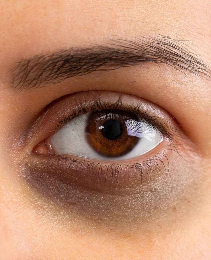 Under-eye Dark Circle Treatment