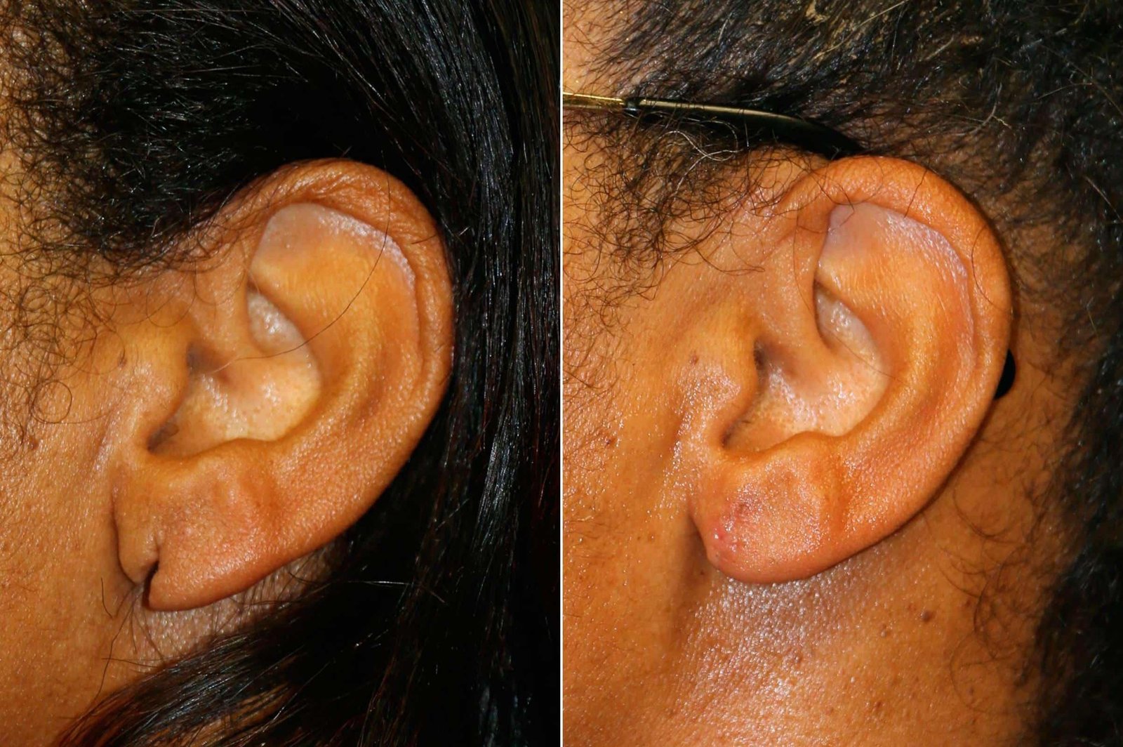 Ear Lobe Repair