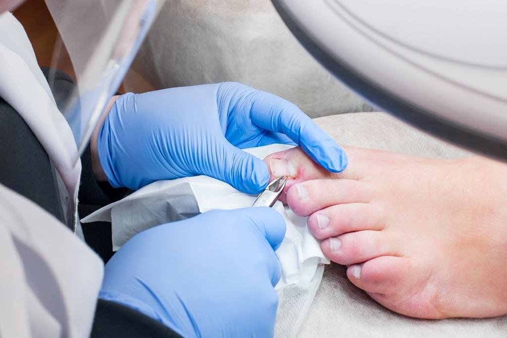 Ingrown Nail Treatment