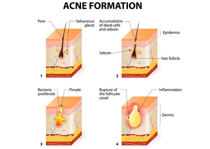 Managing Resistant Acne Vulgaris: Modern Clinical Approaches