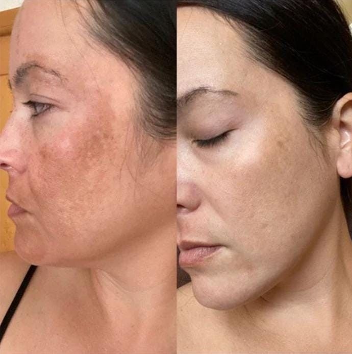 Decoding Melasma and Hyperpigmentation: Clinical Solutions