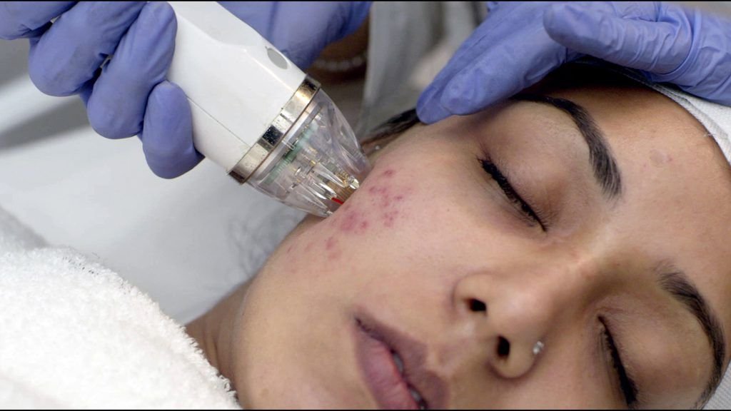 Clinical Microneedling RF (MNRF) for Deep Acne Scars
