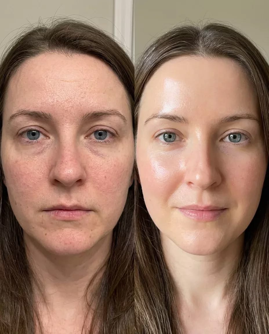 Advanced Anti-Aging: The Role of Collagen Stimulators and Botox