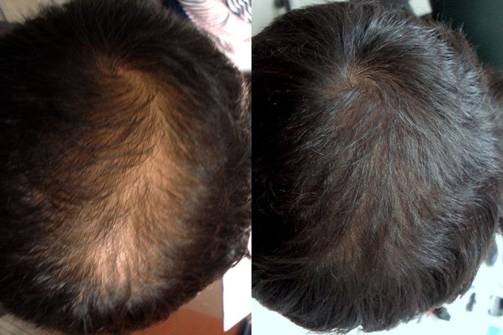 Platelet-Rich Plasma (PRP) Therapy for Androgenetic Alopecia
