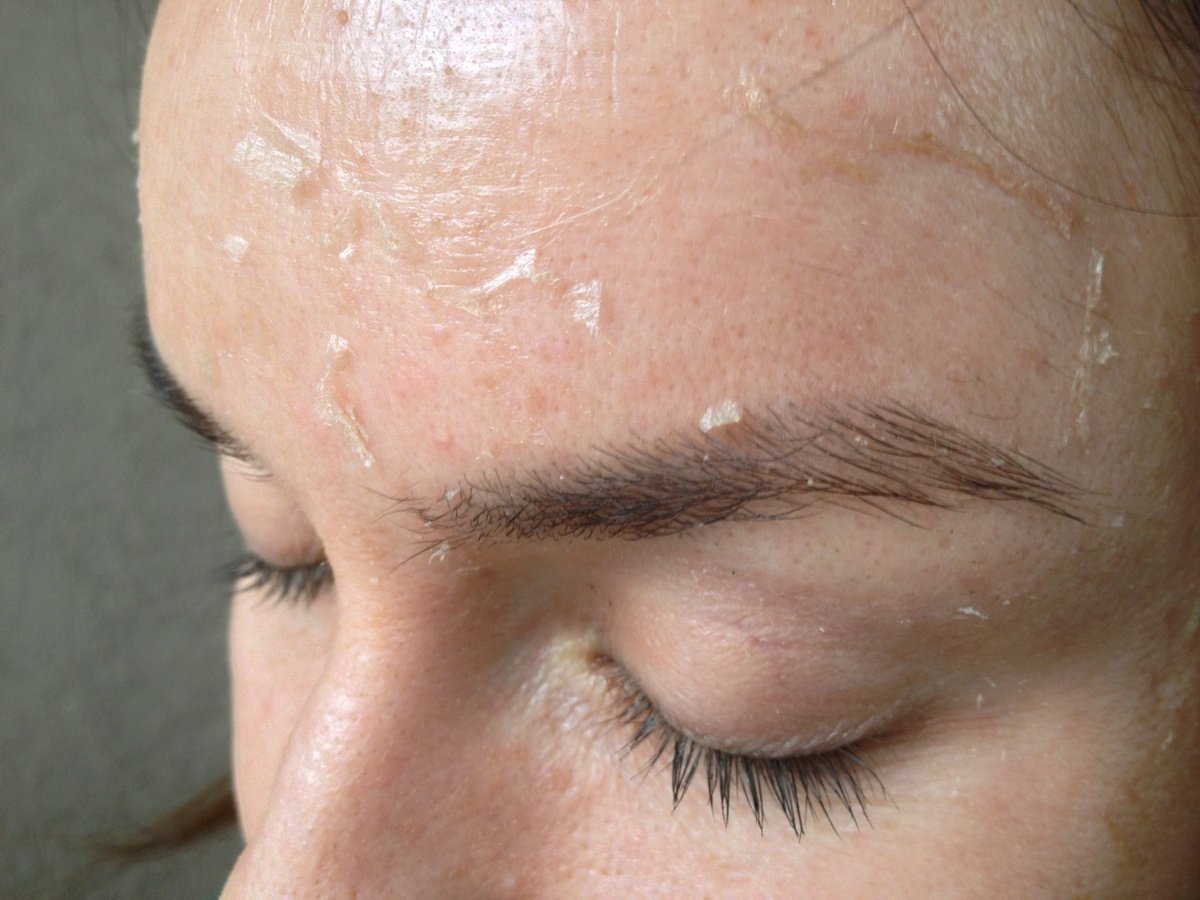 Chemical Peels Decoded: Salicylic, Glycolic, and Yellow Peels