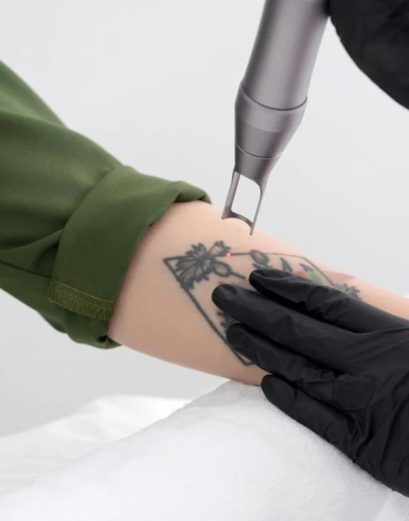 Tattoo Removal: How Q-Switched Nd:YAG Laser Safely Erases Ink