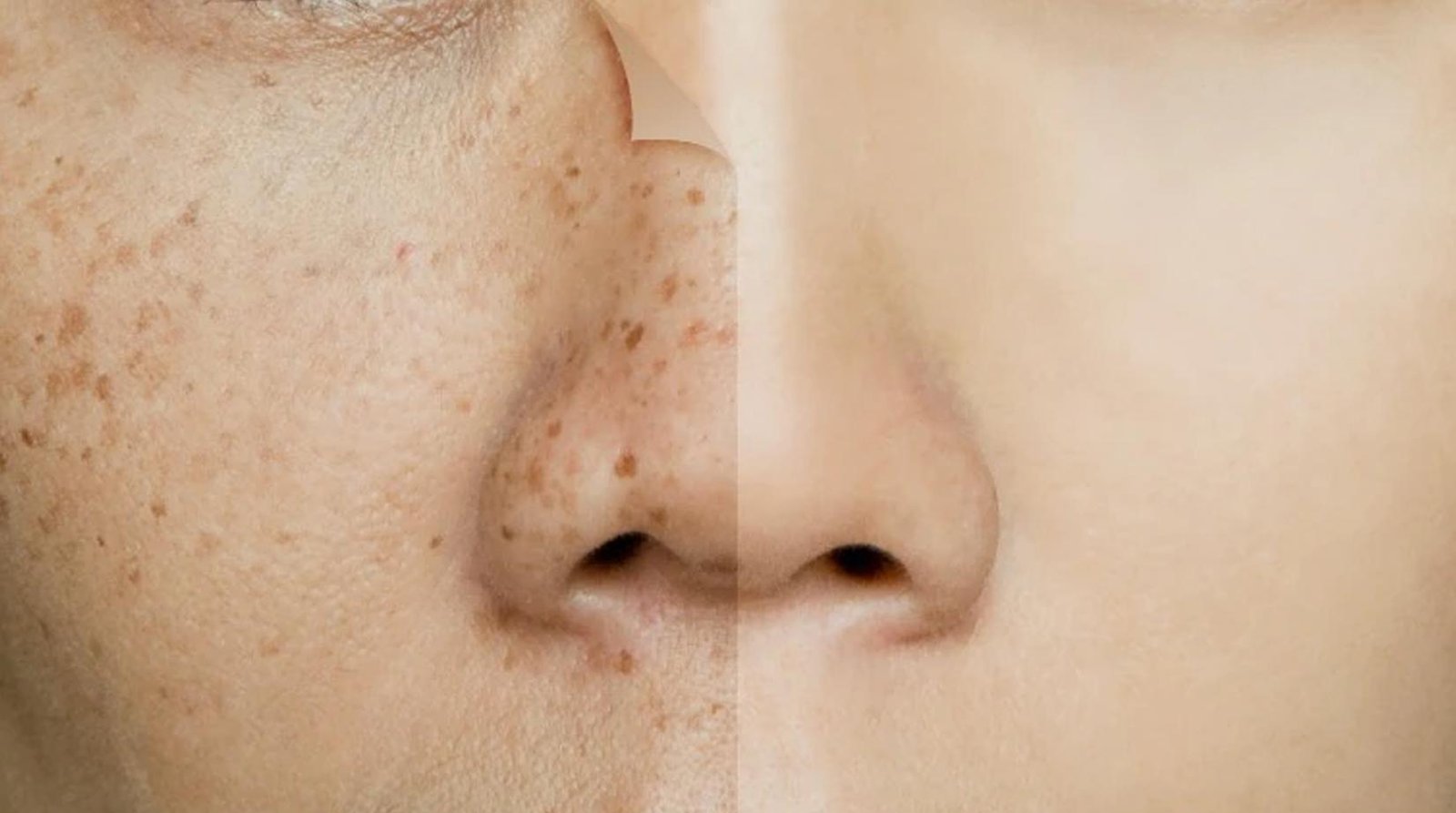 Open Pore Reduction