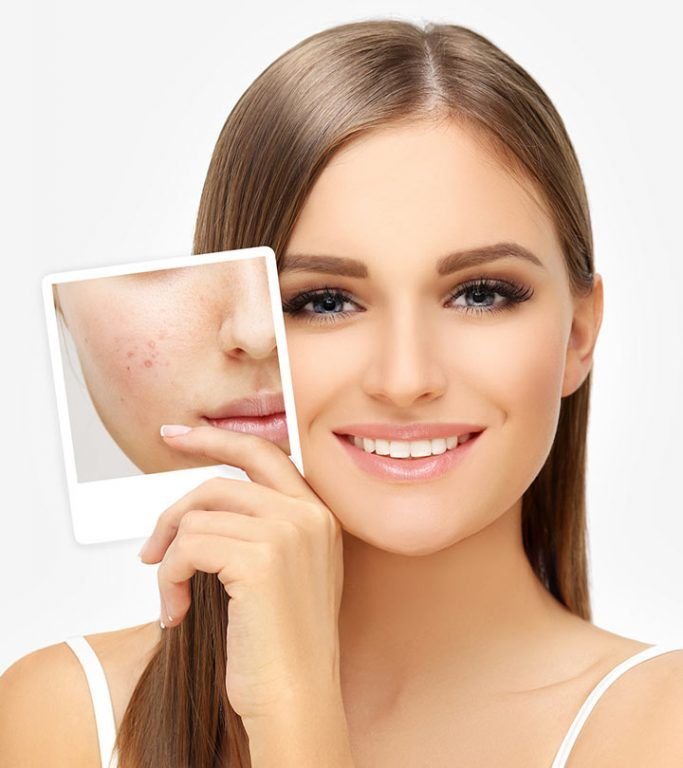Acne Scar Removal