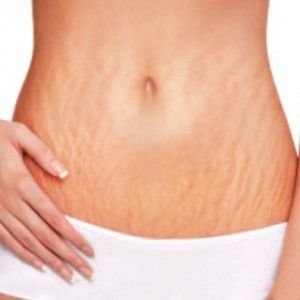 Stretch Mark Treatment