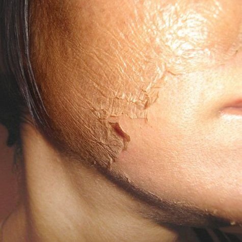 Salicylic Peel