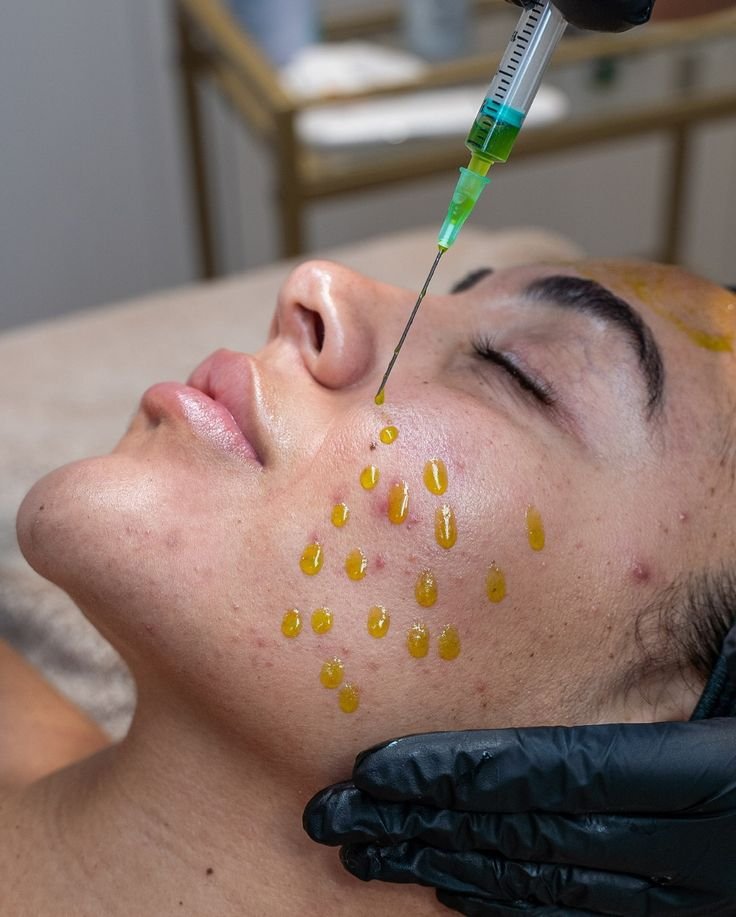 Pigmentation Peel