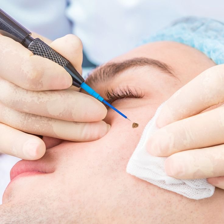 Mole Removal