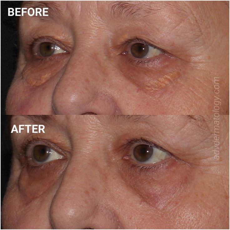 Xanthelasma Treatment