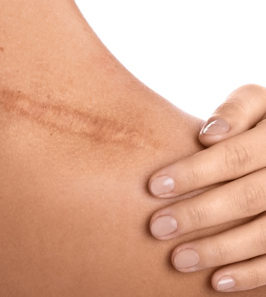 Keloid Scar Treatment