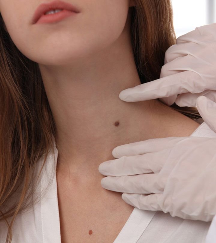 Skin Tag Removal