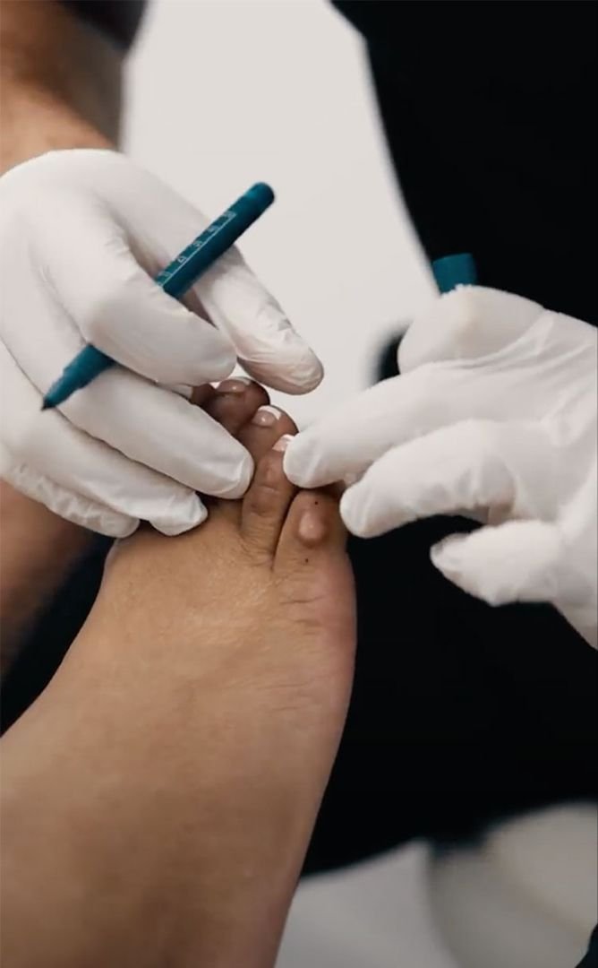 Nail Surgery