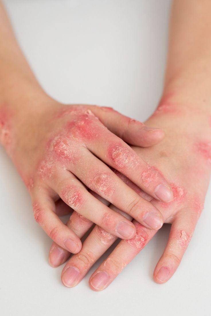 Psoriasis
