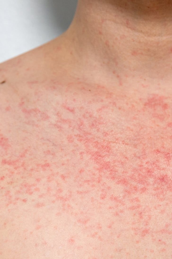 Eczema