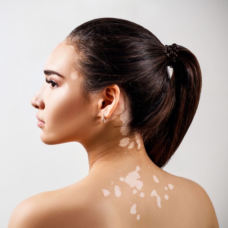 Vitiligo