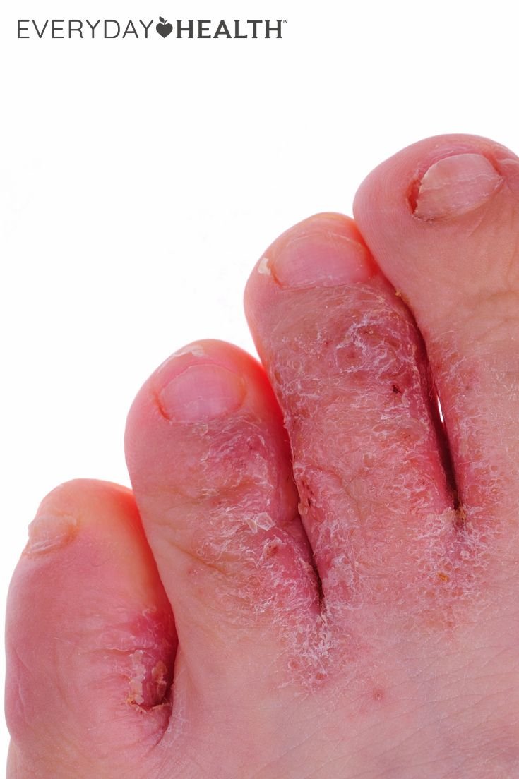 Fungal Infection