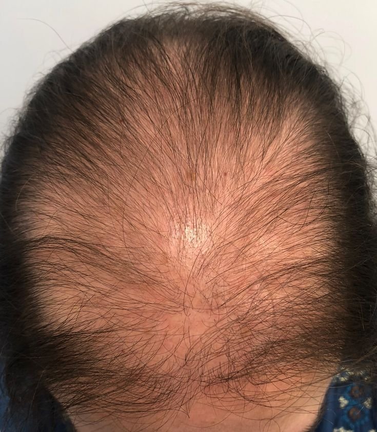 Alopecia