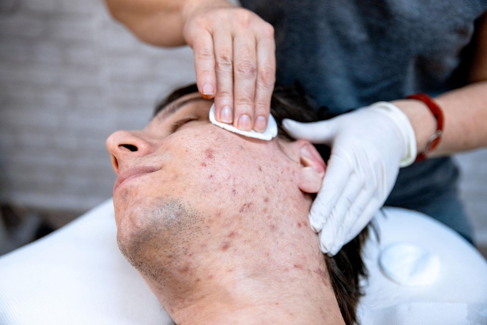Acne & Acne Scar Treatment