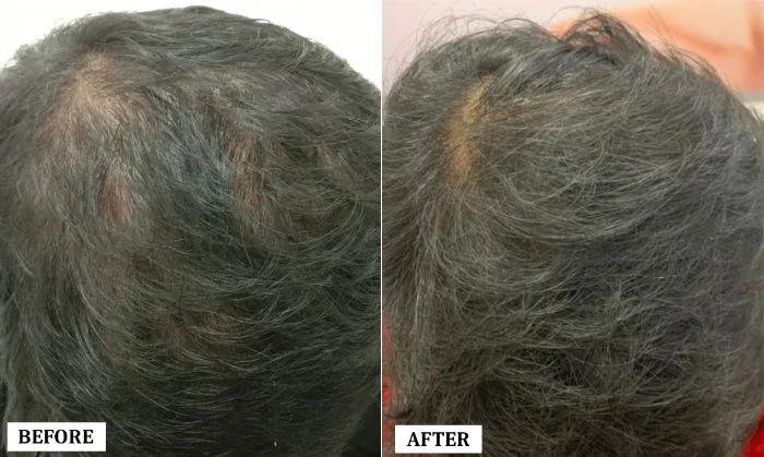 PRP - GFC Therapy