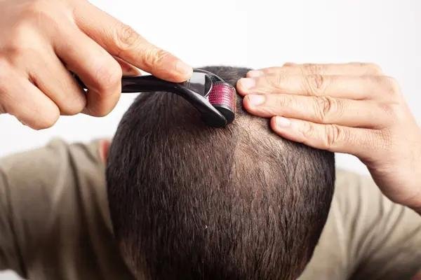 Microneedling for Hair