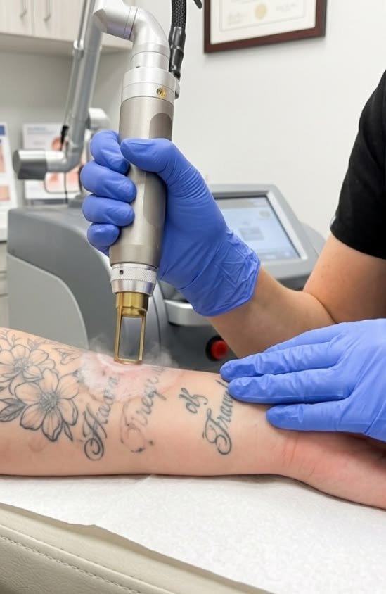 Tattoo Removal
