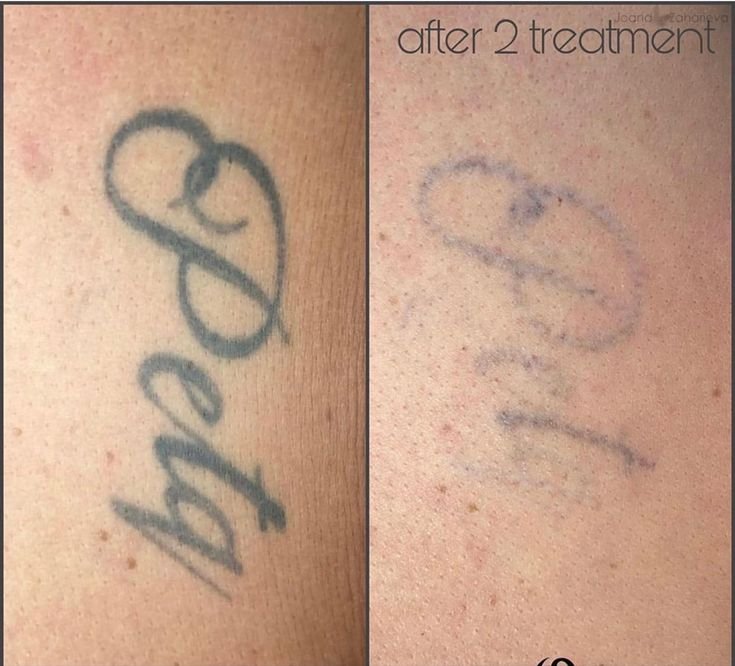 Laser Tattoo Removal