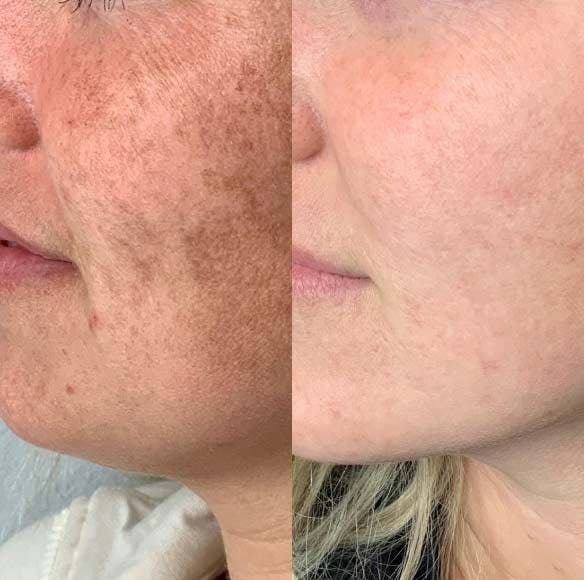 Pigmentation Treatment