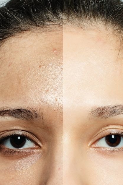 Body Pigmentation & Tanning