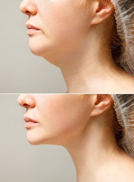 Double Chin Treatment