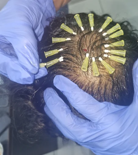 Hair Growth Treatment